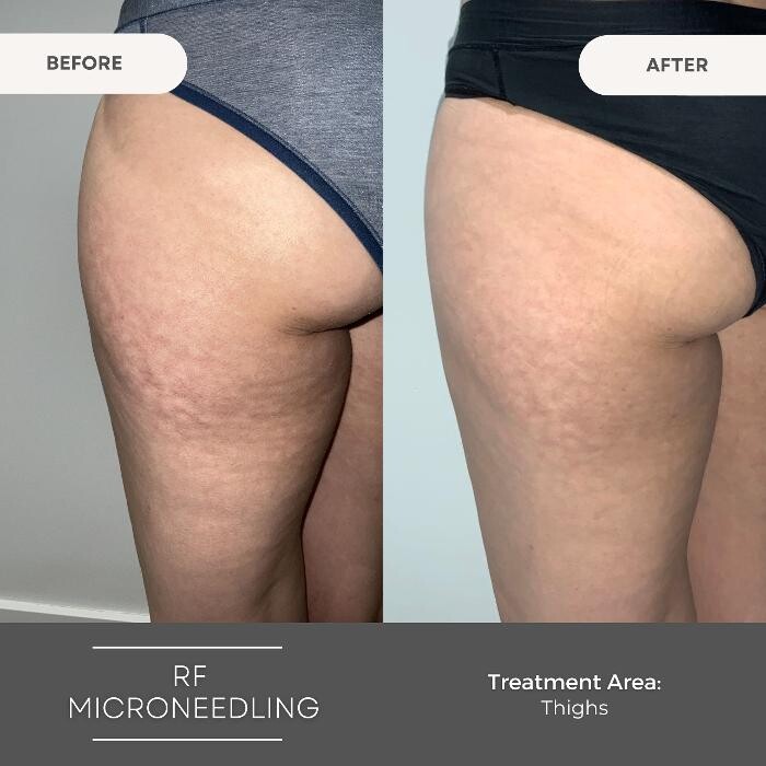 Images Elite Body Contouring Wollongong