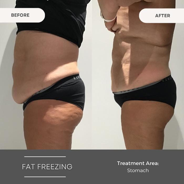 Images Elite Body Contouring Wollongong