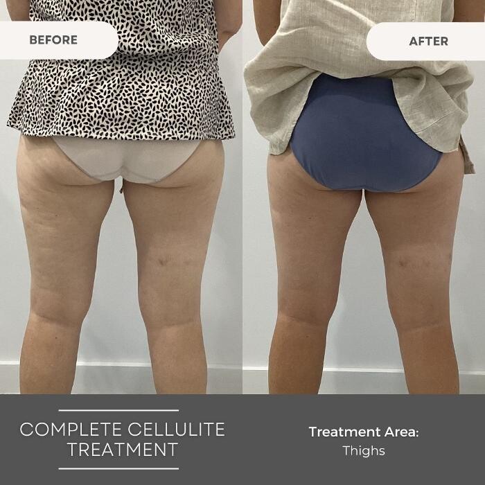 Images Elite Body Contouring Wollongong