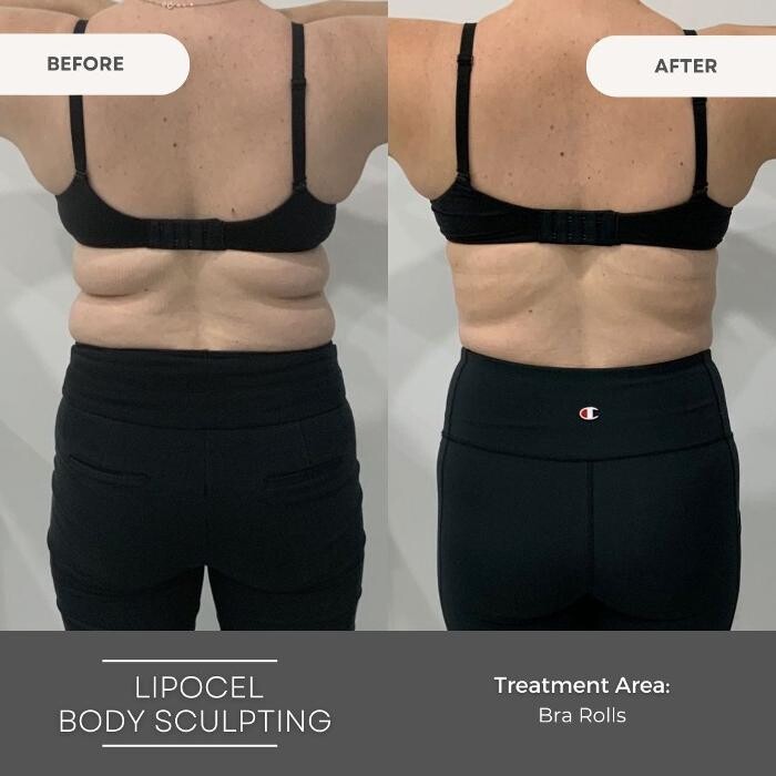 Images Elite Body Contouring Wollongong
