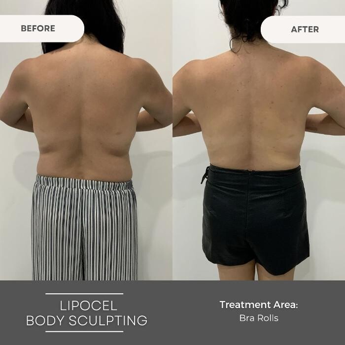 Images Elite Body Contouring Wollongong