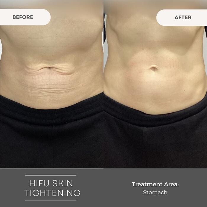 Images Elite Body Contouring Wollongong