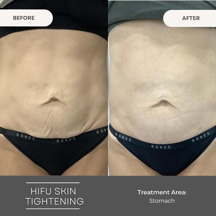 Images Elite Body Contouring Wollongong