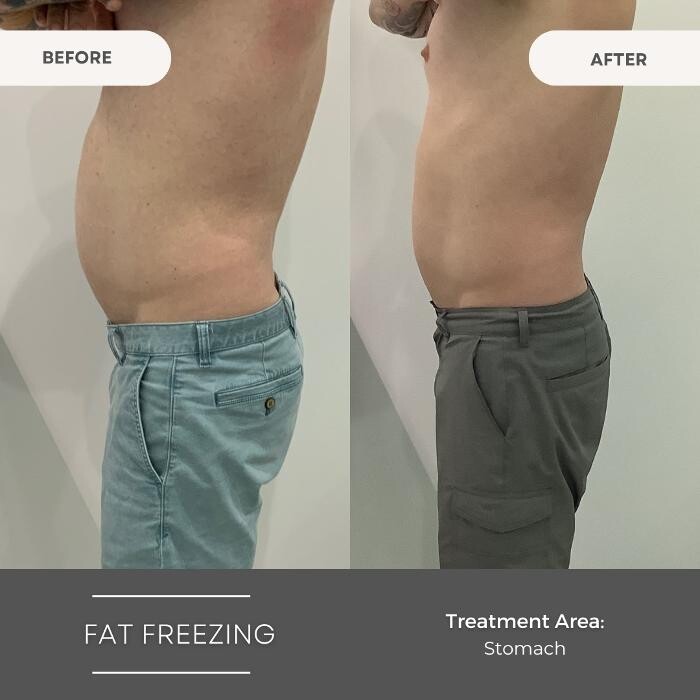 Images Elite Body Contouring Wollongong