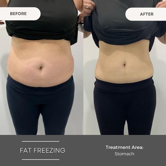 Images Elite Body Contouring Wollongong