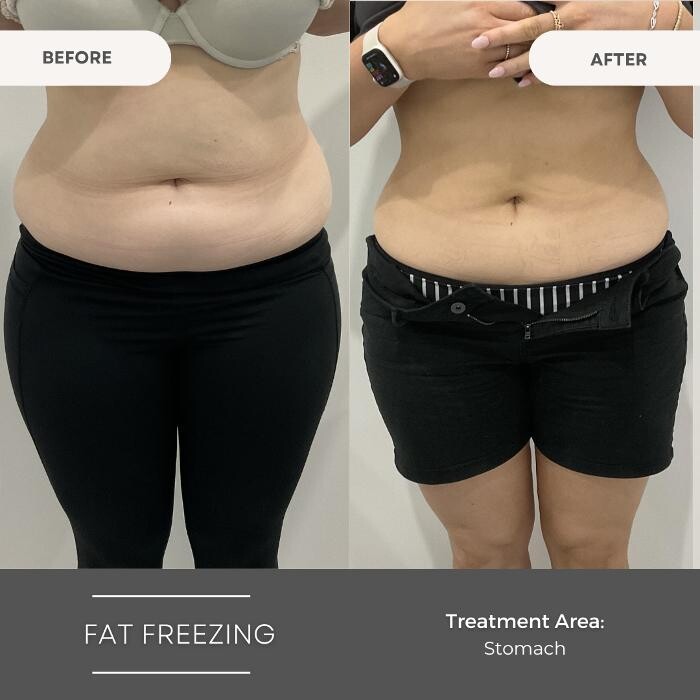 Images Elite Body Contouring Wollongong