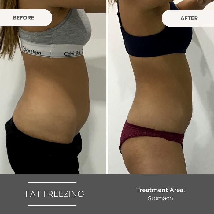 Images Elite Body Contouring Wollongong