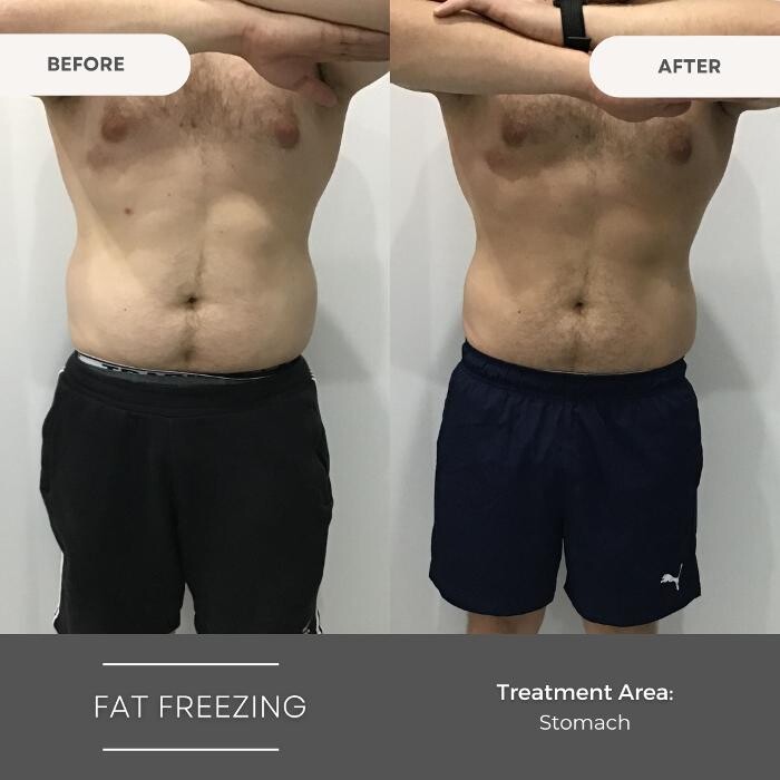 Images Elite Body Contouring Wollongong