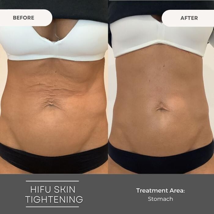 Images Elite Body Contouring Wollongong