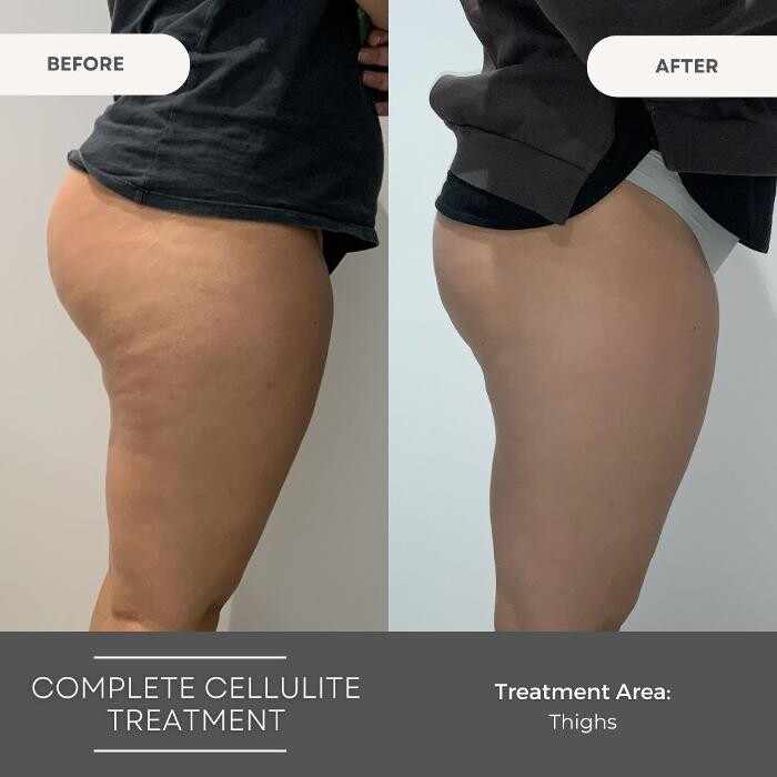 Images Elite Body Contouring Wollongong