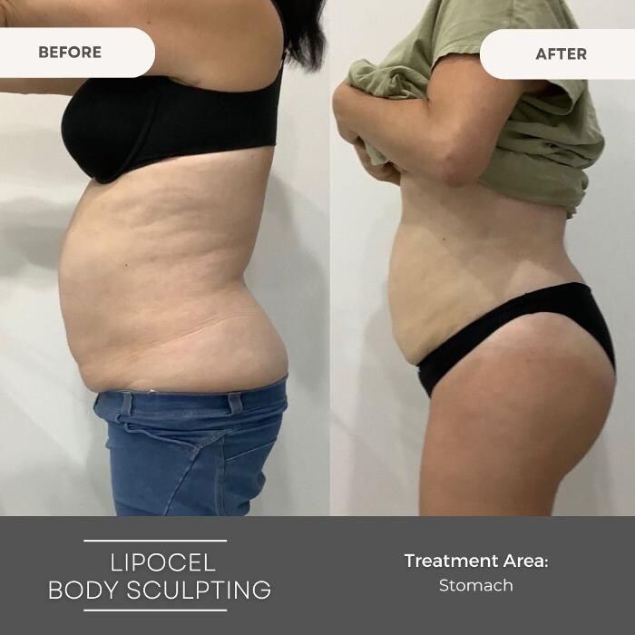 Images Elite Body Contouring Wollongong