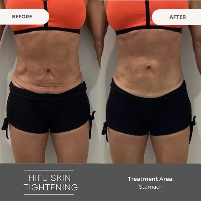 Images Elite Body Contouring Wollongong