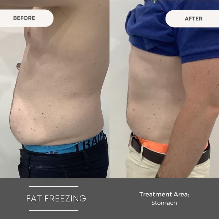 Images Elite Body Contouring Wollongong