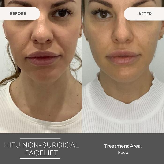 Images Elite Body Contouring Wollongong