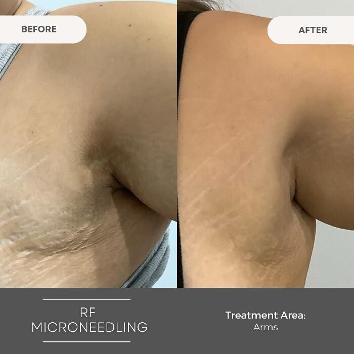 Images Elite Body Contouring Wollongong