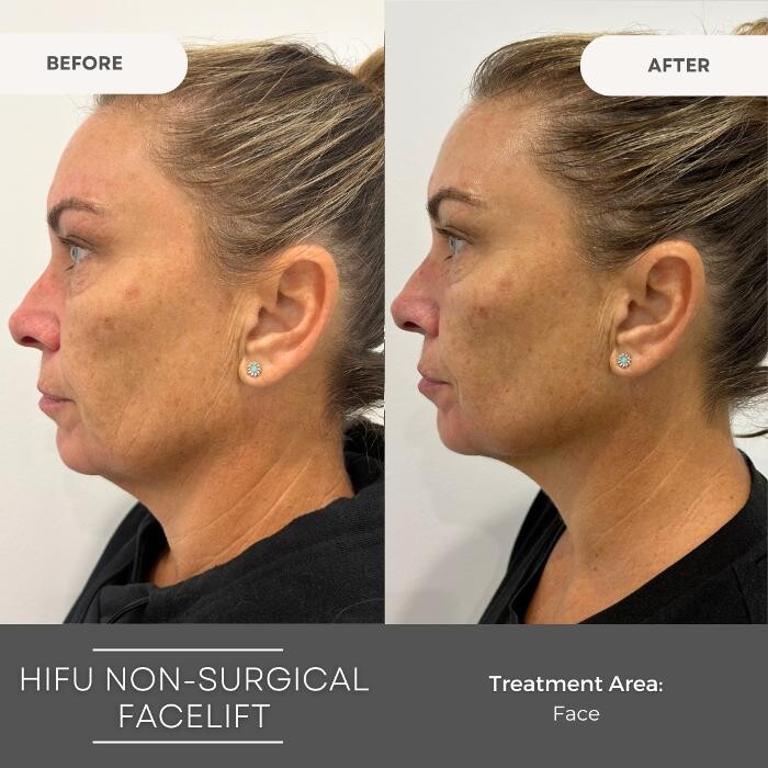 Images Elite Body Contouring Wollongong