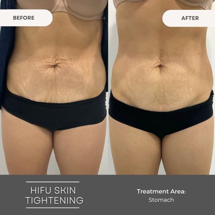 Images Elite Body Contouring Wollongong