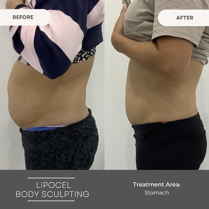 Images Elite Body Contouring Wollongong