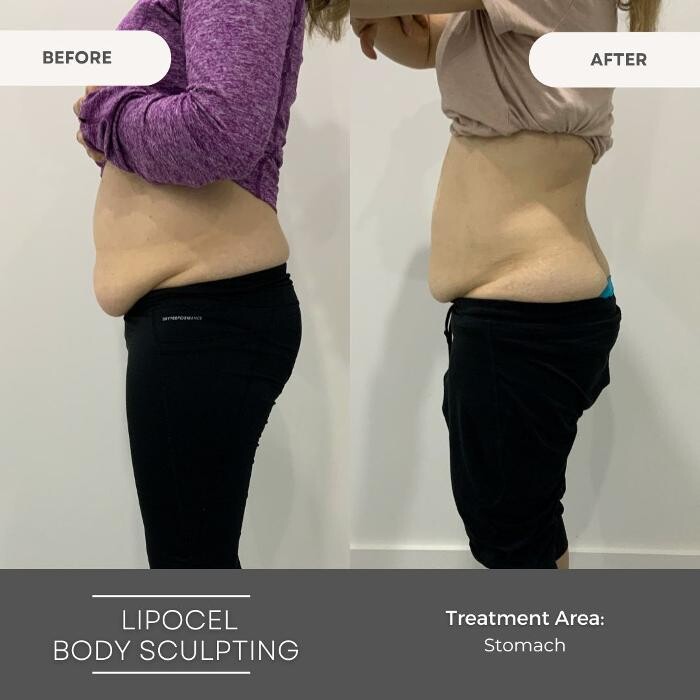 Images Elite Body Contouring Wollongong