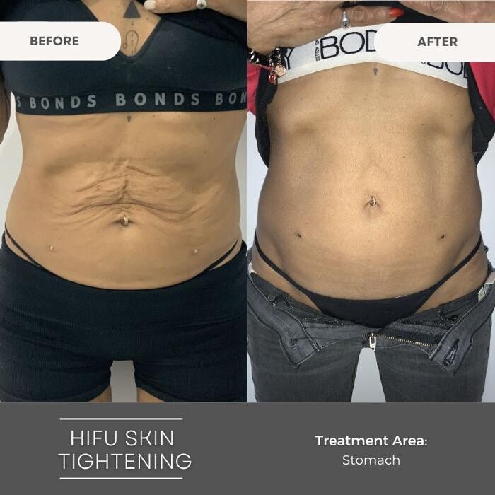 Images Elite Body Contouring Wollongong