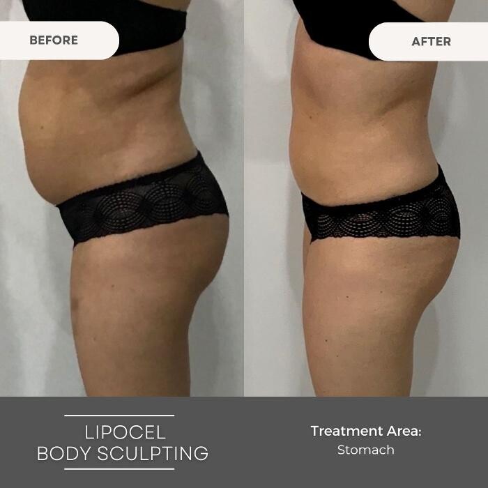 Images Elite Body Contouring Wollongong
