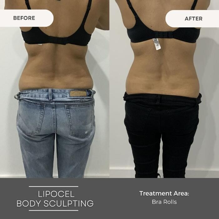 Images Elite Body Contouring Wollongong