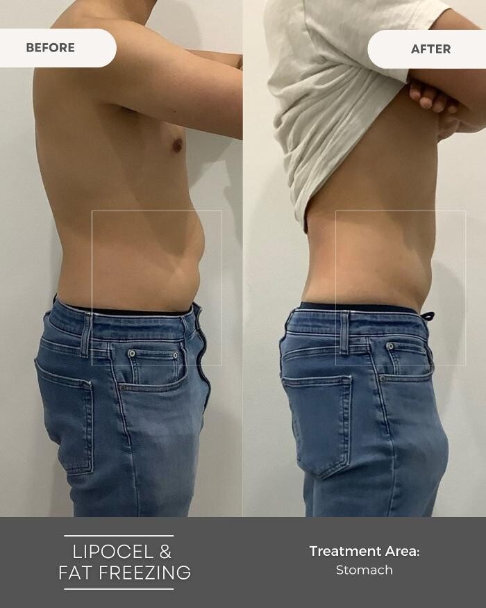 Images Elite Body Contouring Wollongong