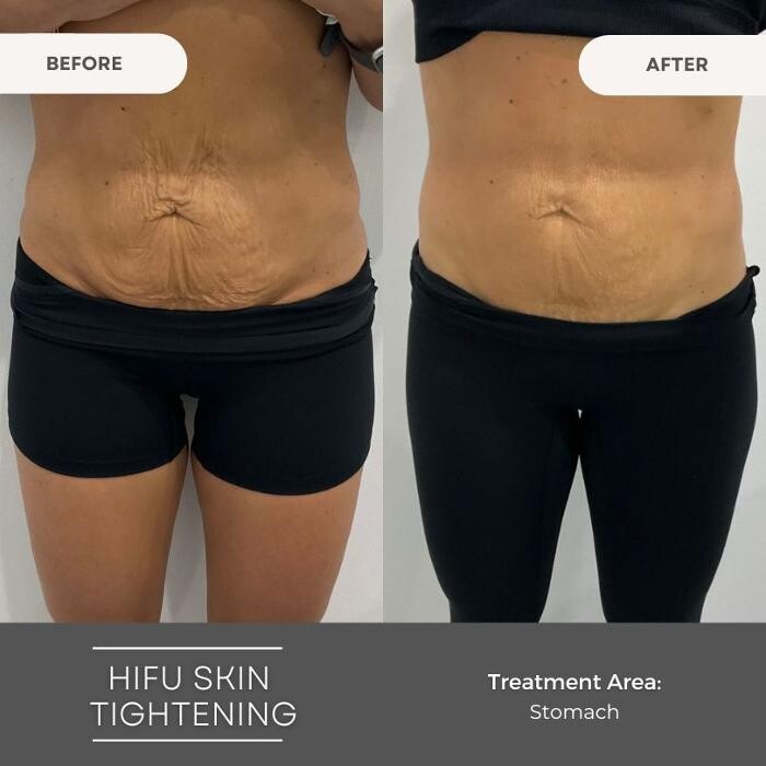 Images Elite Body Contouring Wollongong