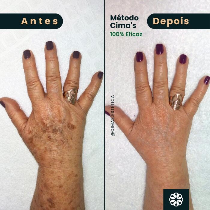 Images Cima´s Estética - Remoção de Manchas Senis em São Lourenço