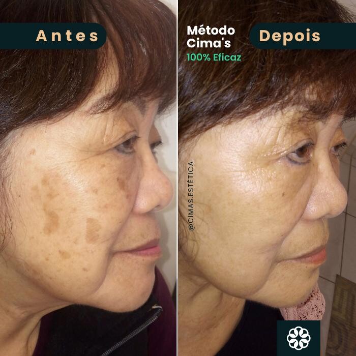Images Cima´s Estética - Remoção de Manchas Senis em São Lourenço