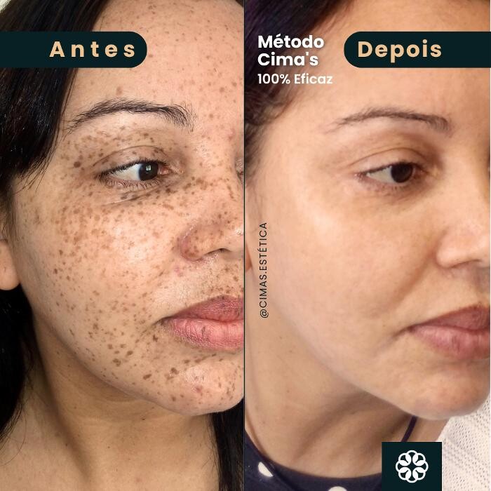 Images Cima´s Estética - Remoção de Manchas Senis em São Lourenço