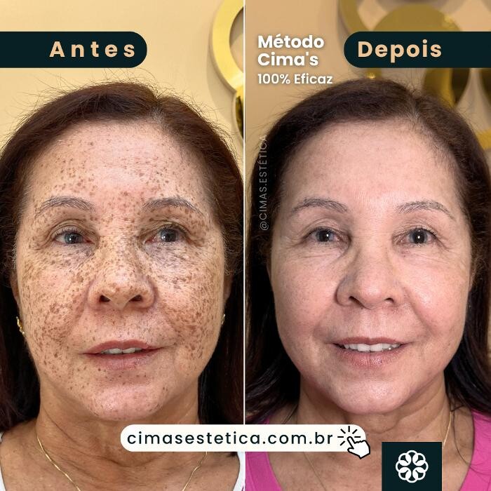 Images Cima´s Estética - Remoção de Manchas Senis em São Lourenço