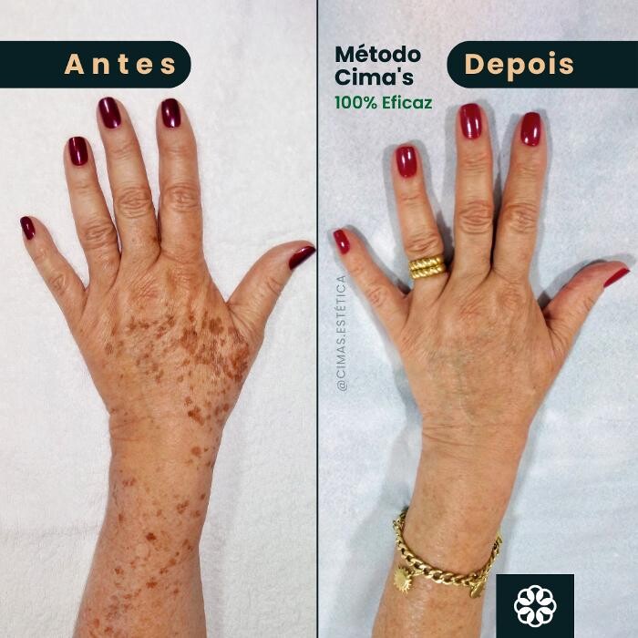 Images Cima´s Estética - Remoção de Manchas Senis em São Lourenço