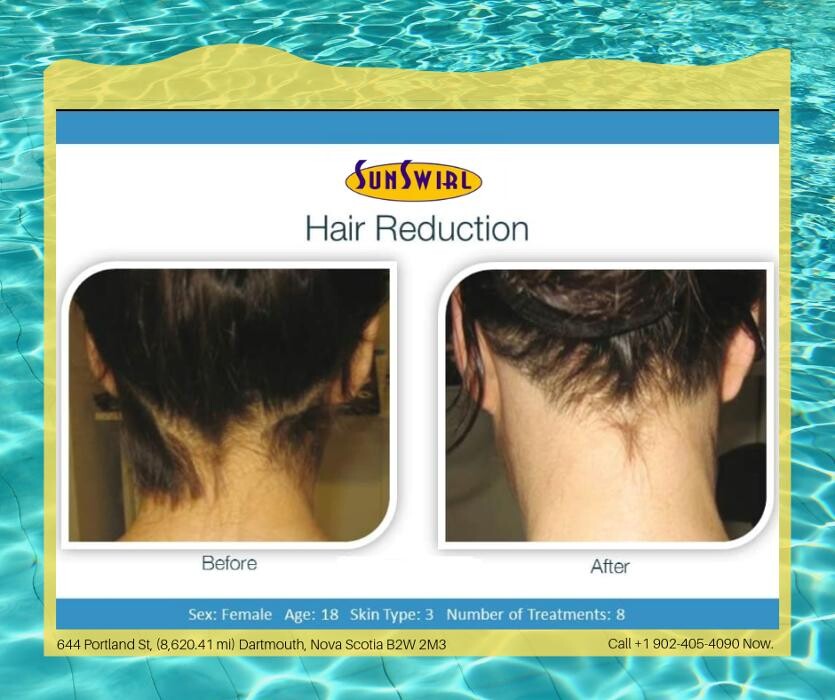 Images Sunswirl Laser and Esthetics