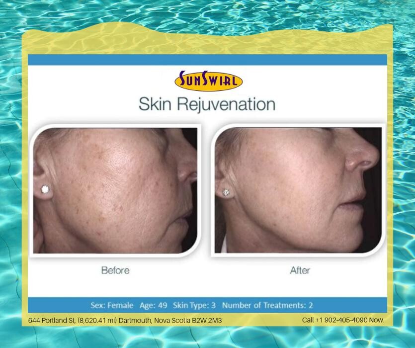 Images Sunswirl Laser and Esthetics