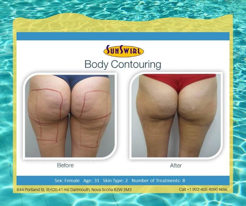 Images Sunswirl Laser and Esthetics