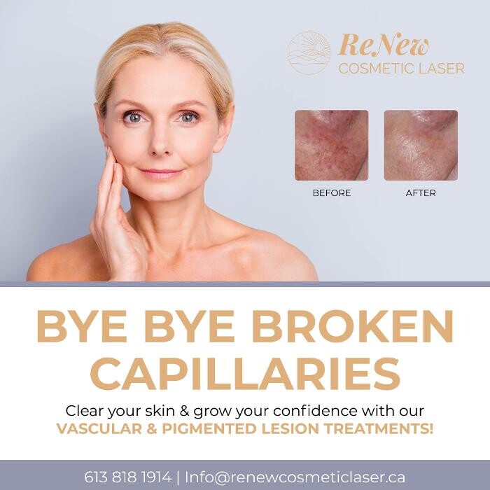 Images ReNew Cosmetic Laser