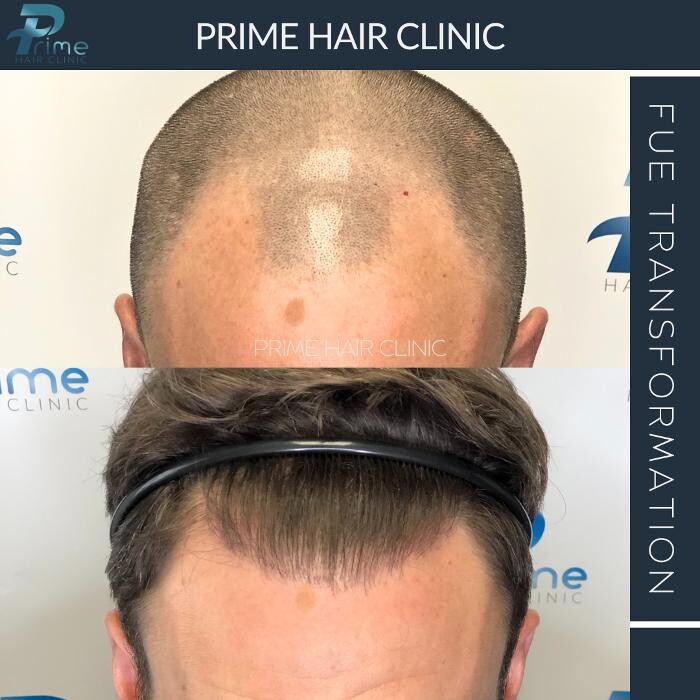 Images Prime Hair Clinic