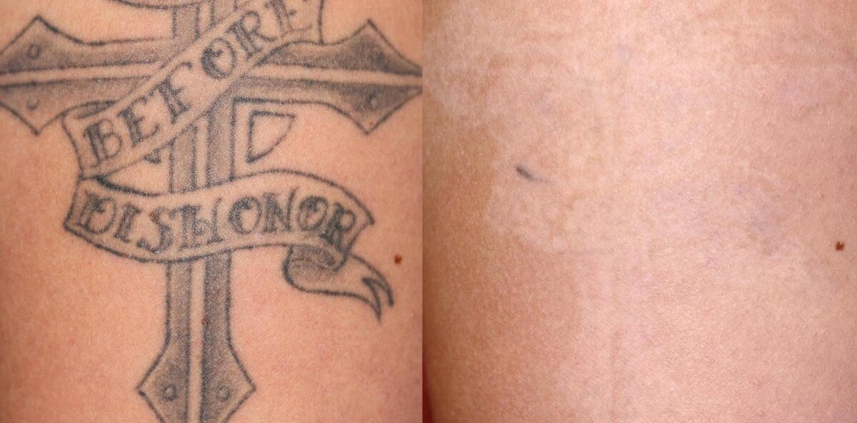 Images Amendermis Laser Clinic - Tattoo Removal