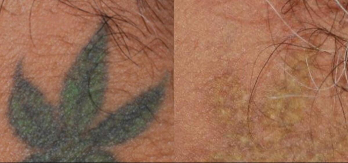 Images Amendermis Laser Clinic - Tattoo Removal