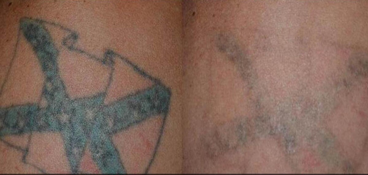 Images Amendermis Laser Clinic - Tattoo Removal