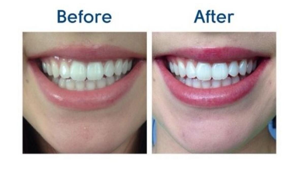 Images Teeth Whitening Kit