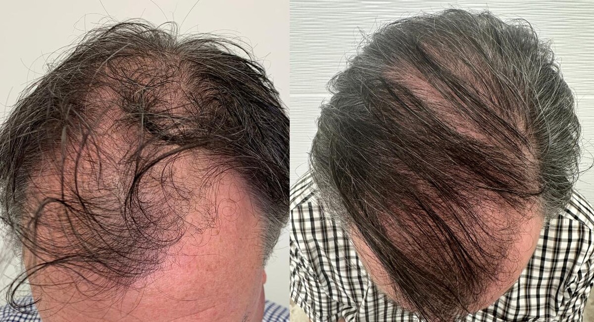 Images De Haar Hair Restoration