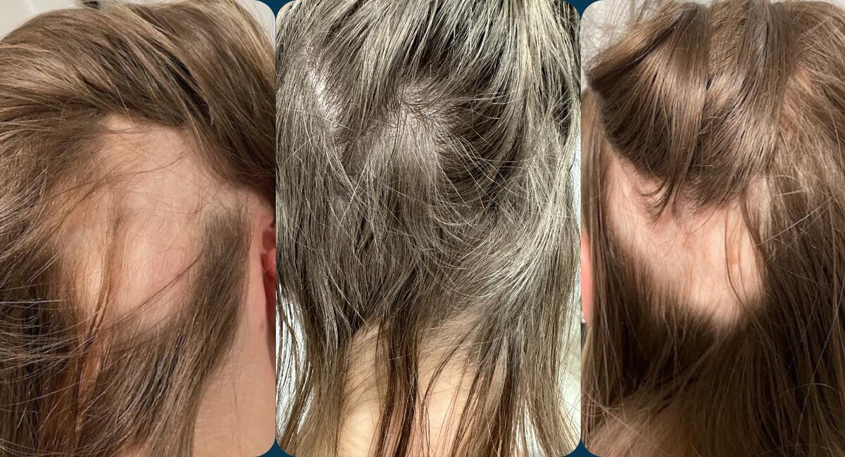 Images De Haar Hair Restoration