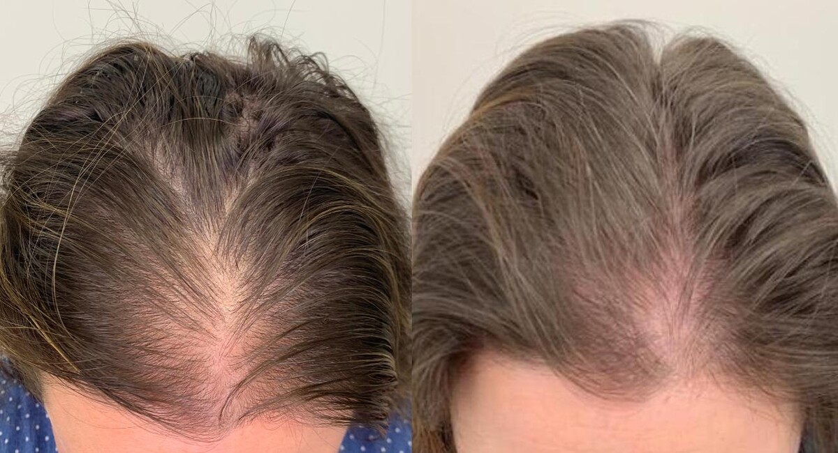 Images De Haar Hair Restoration