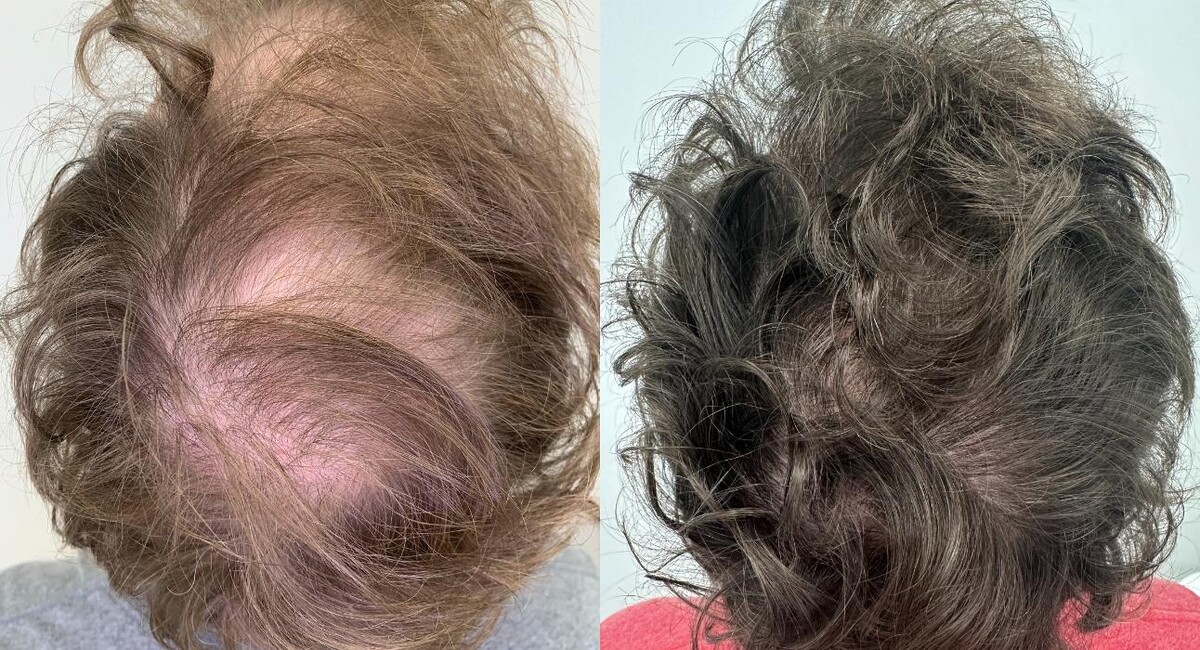 Images De Haar Hair Restoration