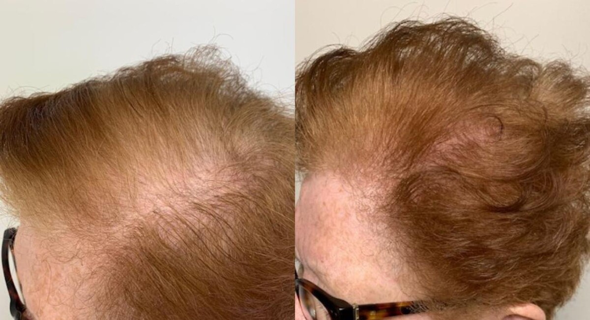 Images De Haar Hair Restoration