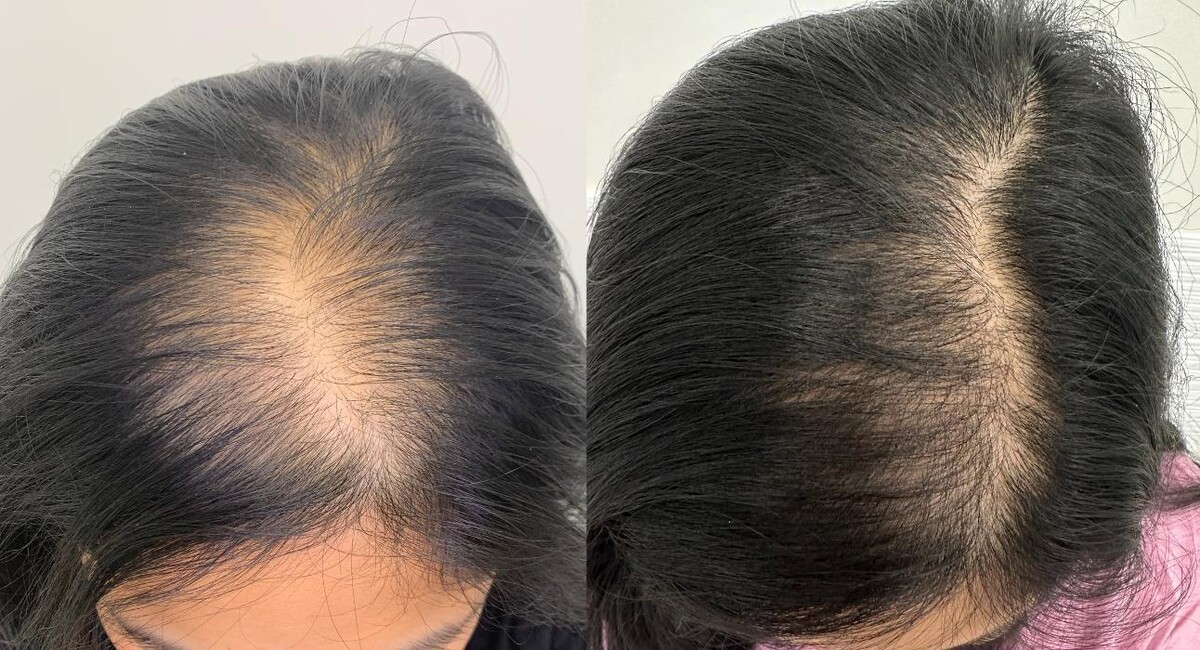 Images De Haar Hair Restoration