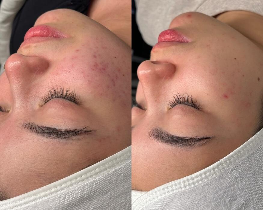 Images Reva Facials