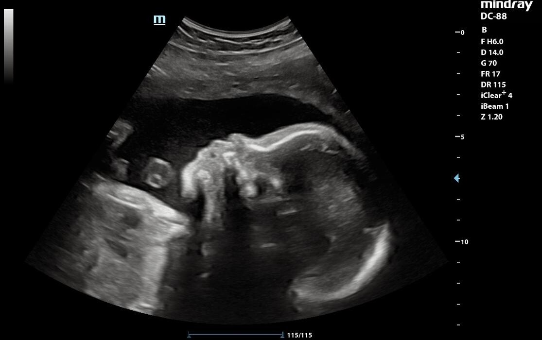 Images UC Baby Winnipeg (Previous Fetoscan)